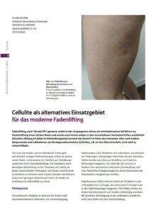 Fadenlifting bei Cellulite bei Dr. Arna Shab