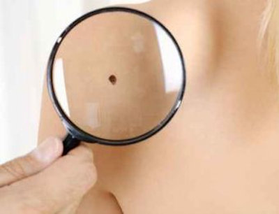 skin cancer screening in our practice
