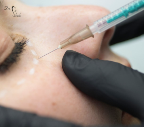 2023-08-09 14_22_11-Dr. Shab (@drshab_) • Instagram-Fotos und -Videos Faltenunterspritzung der Augenpartie mit Hyaluron