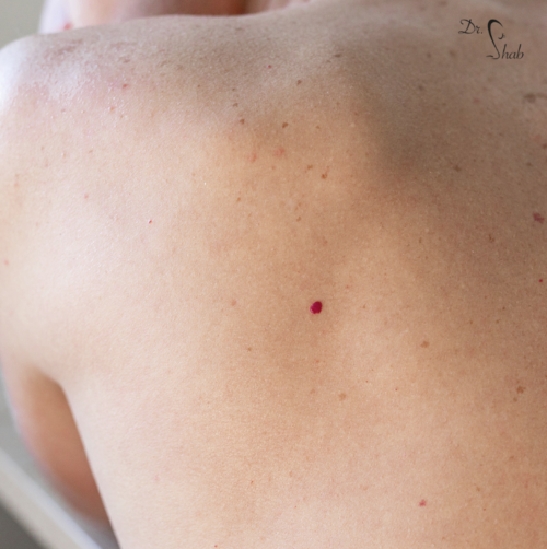 Hämangiome_Med_Aesthet Blutschwämmchen entfernen mittels Laser bei Dr. Shab