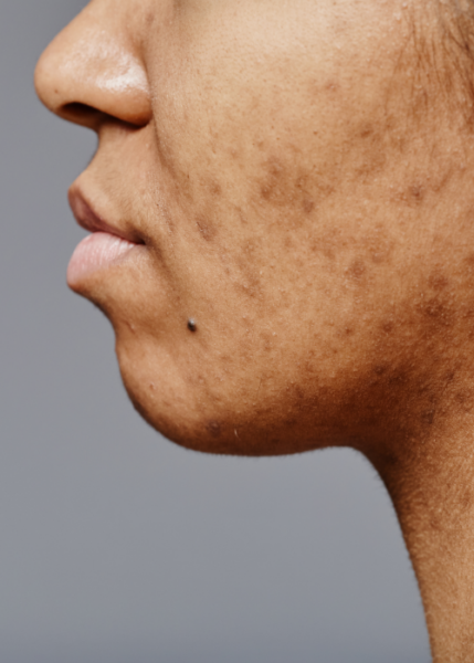 Aknenarben-Med-Aesthet Frau mit Pigmentflecken vor Exosomenbehandlung